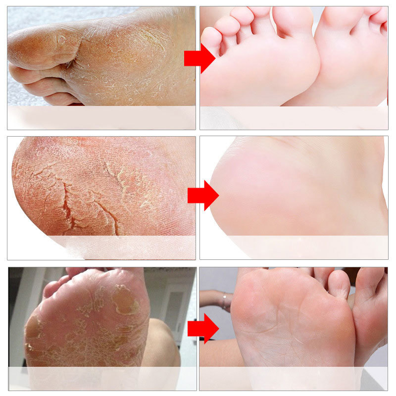 Fußpeeling-Masken, Pediküre-So – Foot Mask Peeling Bewertung und Preis